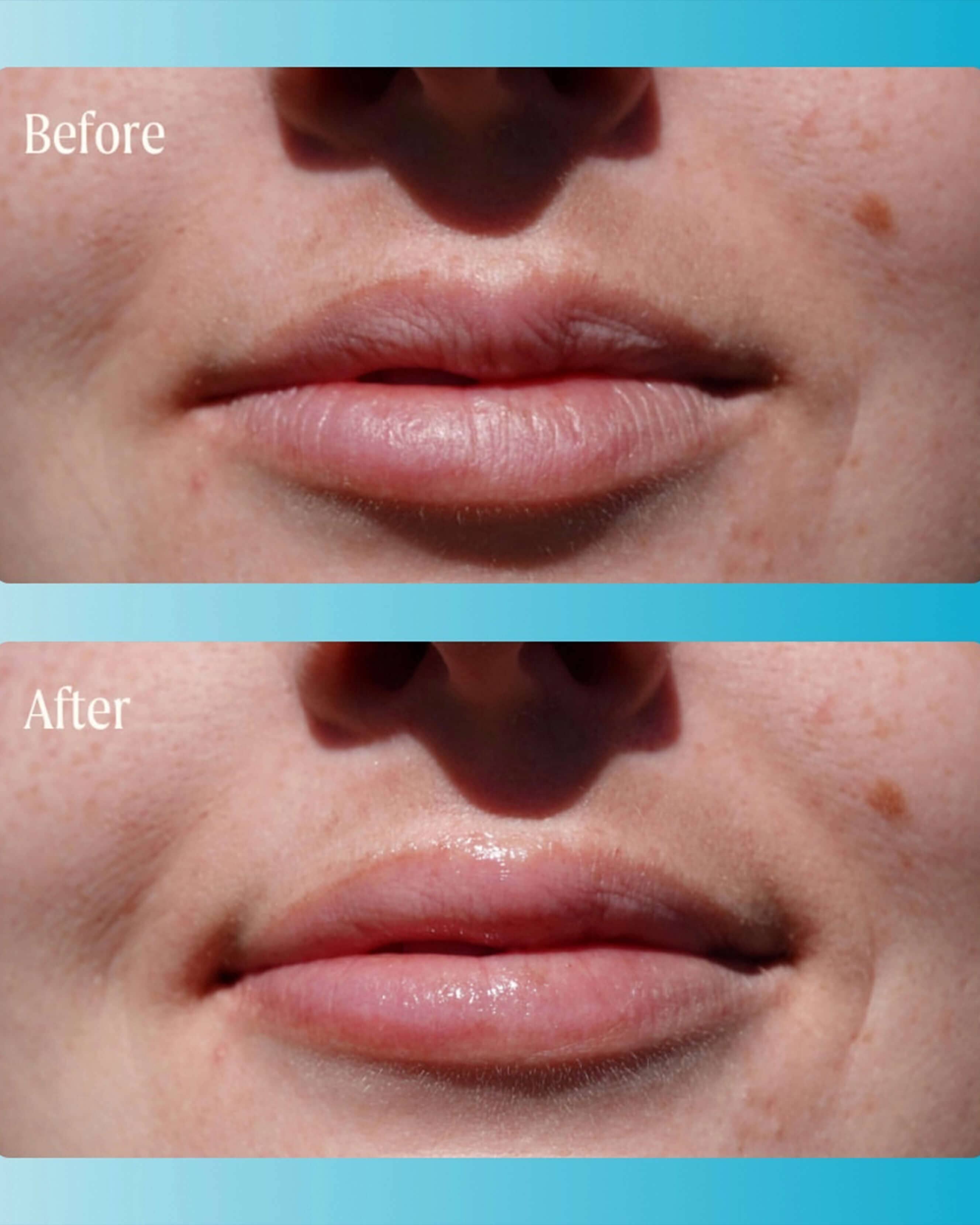 Supermelt Hyaluronic Plumping Lip Treatment