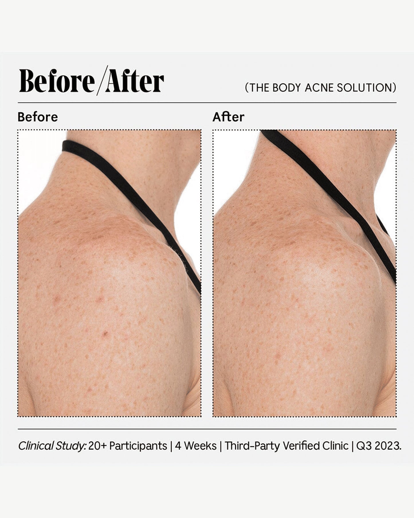 The Body Acne Solution