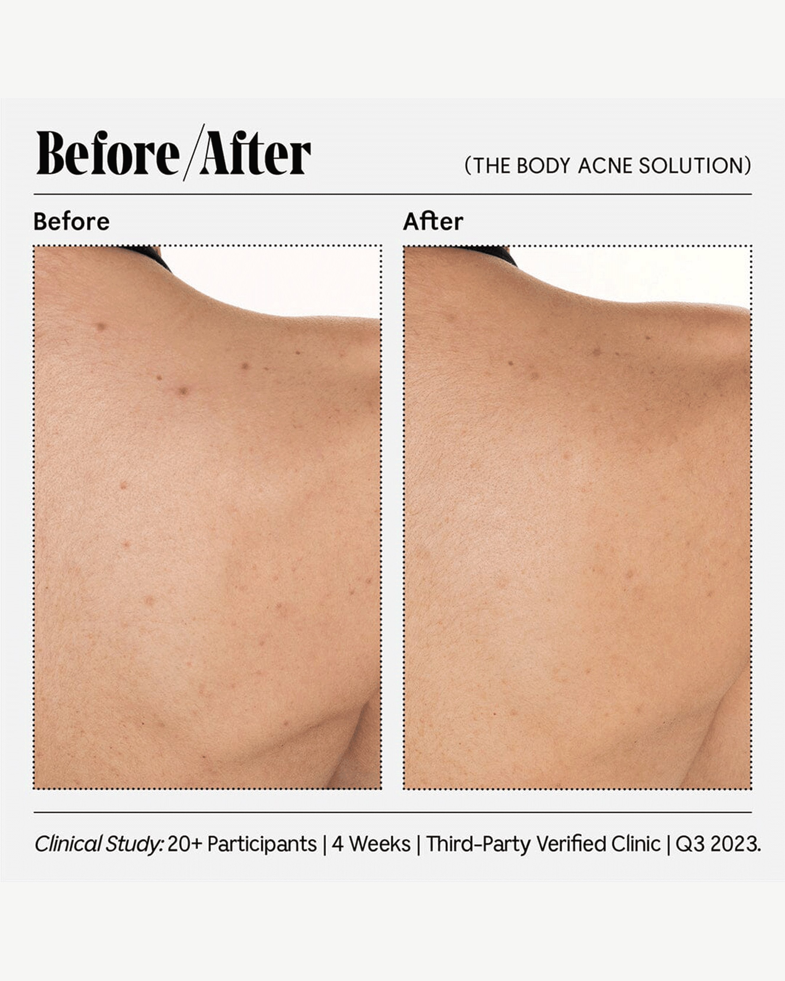 The Body Acne Solution