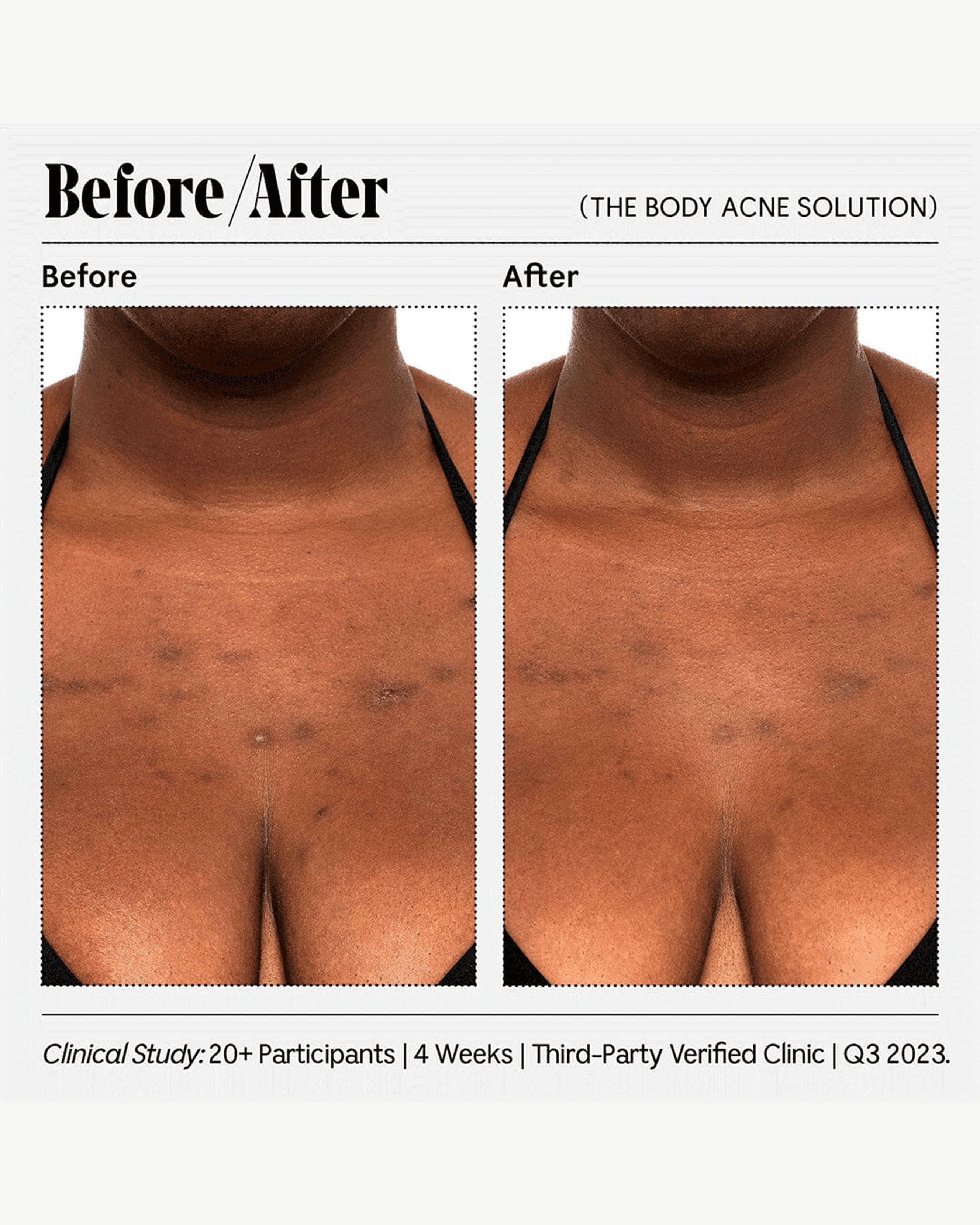 The Body Acne Solution